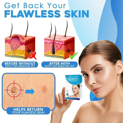 SMART Auto micro skin tag remover