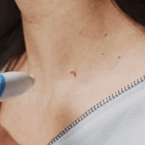 SMART Auto micro skin tag remover